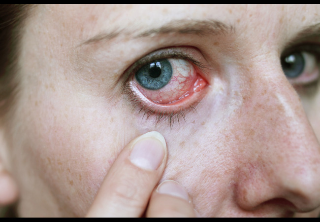Eye Infection Symptoms & Care)