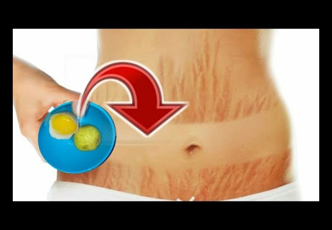 Stretch Mark Removal Food