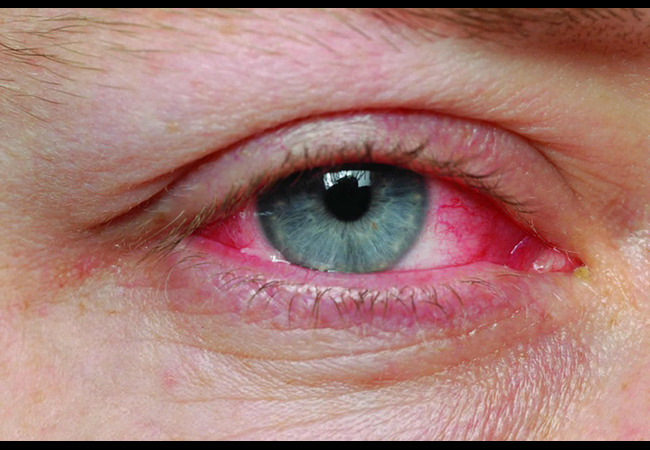 Eye Infection Symptoms & Care