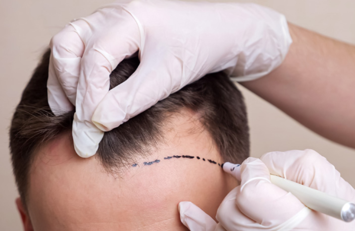 Hair Transplant Hair Transplant