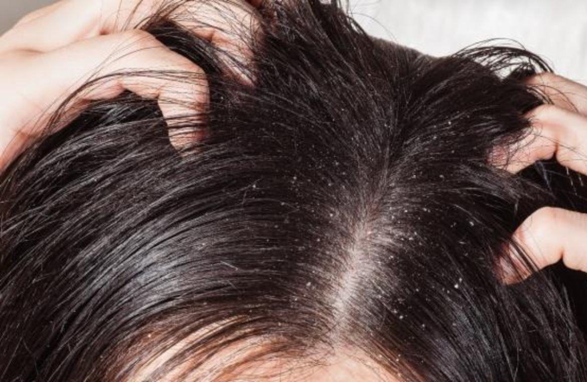 Hair problem in winter Hair problem in winter