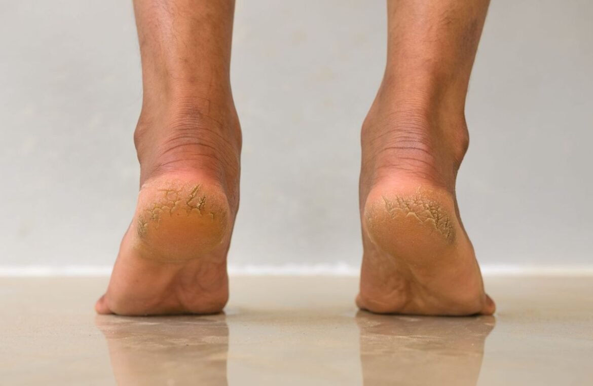 Heel Cracking Remedies Heel Cracking Remedies