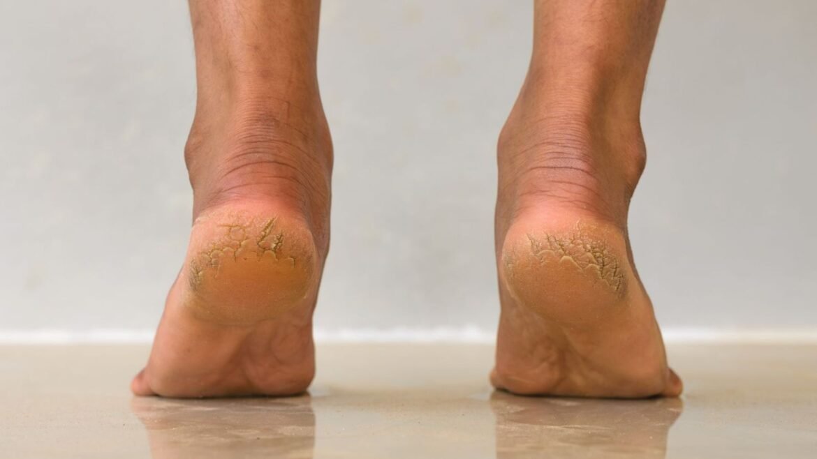 Cracked Heels Care