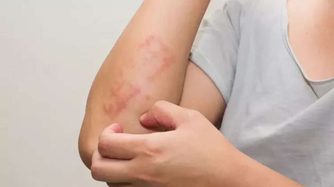 Monsoon Skin Problem Monsoon Skin Problem