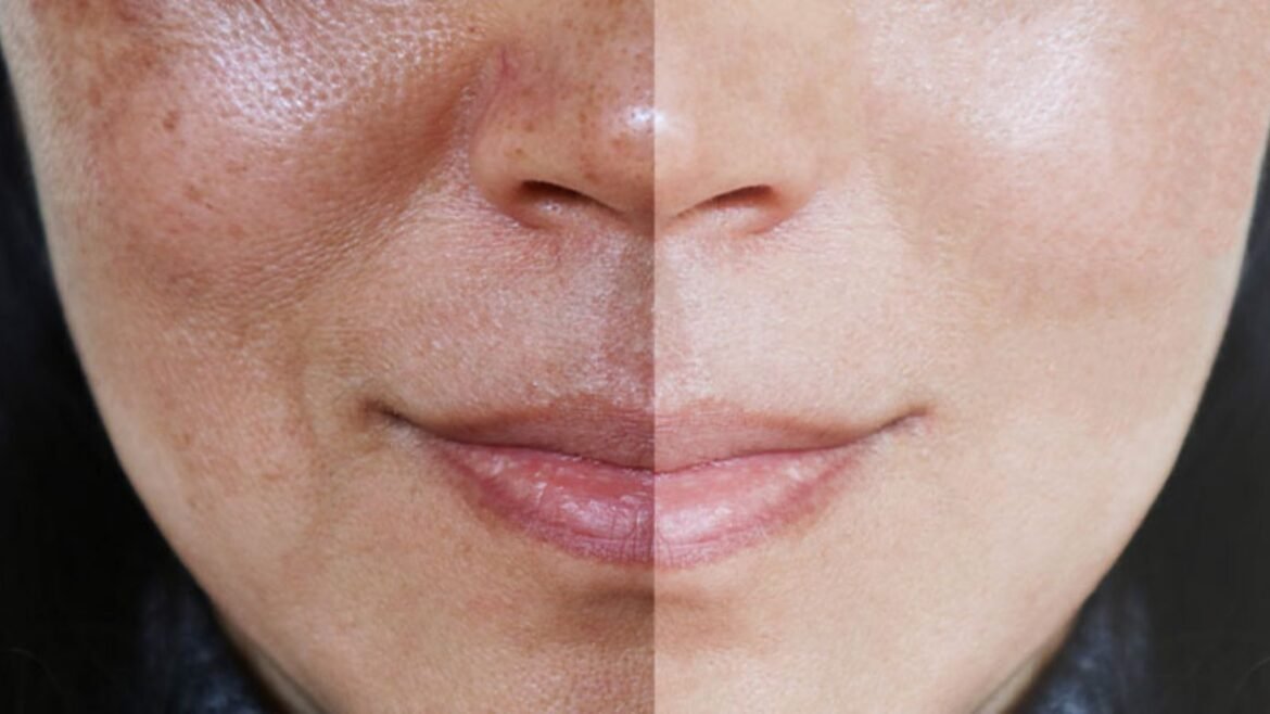 Pigmentation Problem in Monsoon Pigmentation Problem in Monsoon