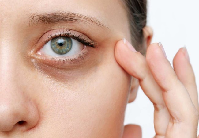 dark circles treatment