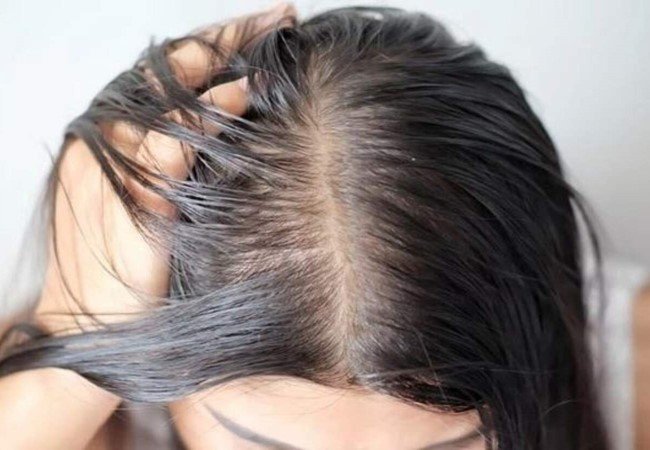 Hair fall due to oily scalp