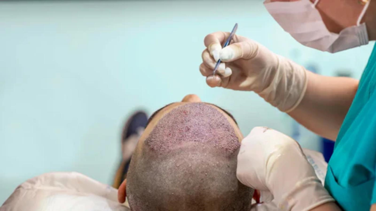 hair transplant tips