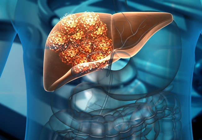 Liver Cancer
