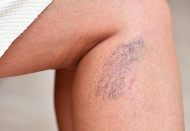 Varicose Veins