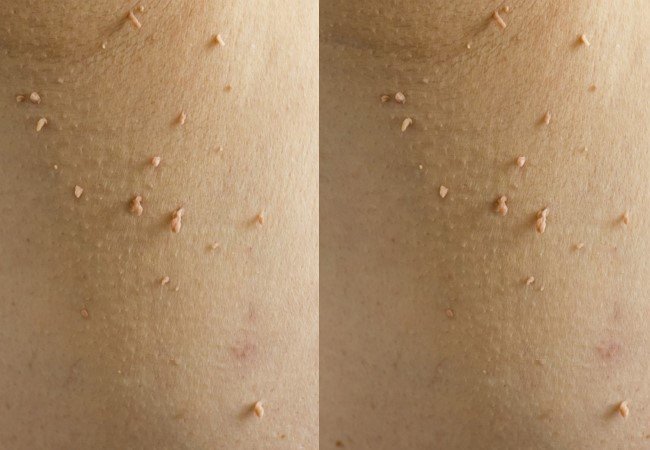 Warts
