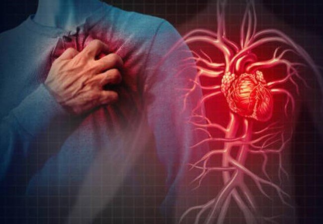 heart attack