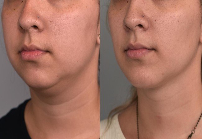Face Fat