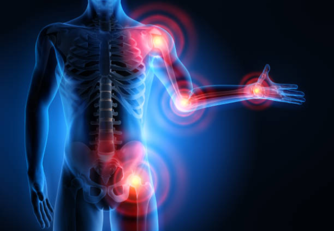 Arthritis Arthritis