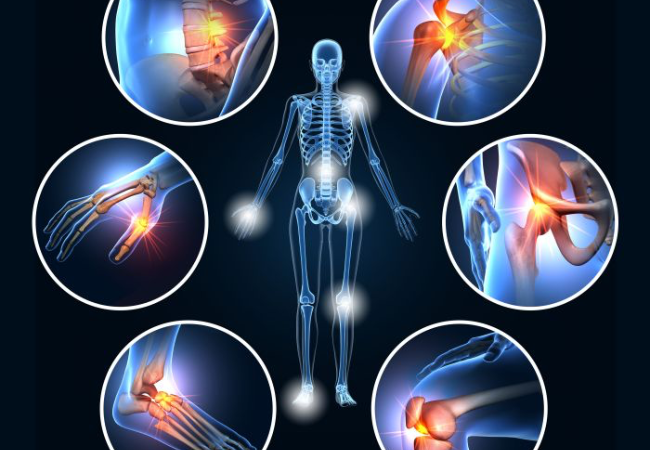 Arthritis