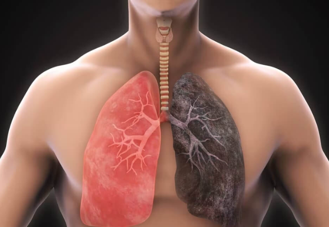 Chronic Lung Disease Chronic Lung Disease