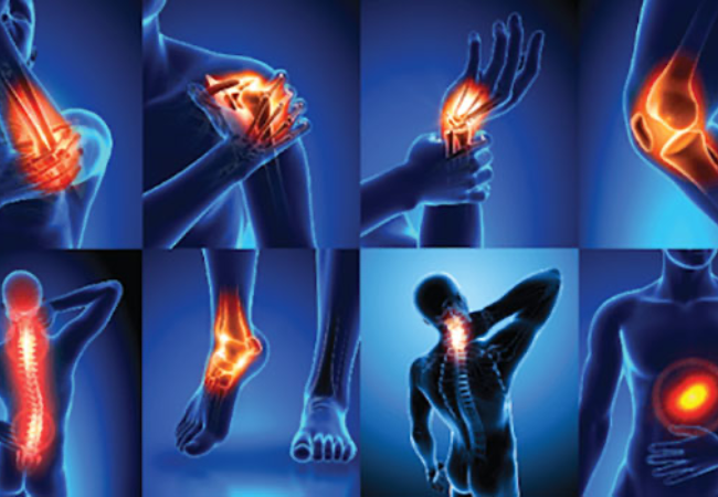 Arthritis