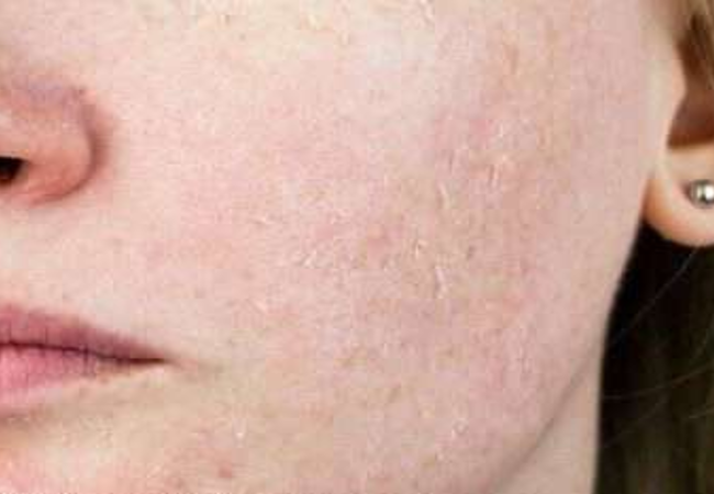 Dry Skin